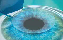 レーシック(LASIK)中の目の様子