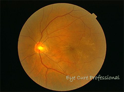 黄斑上膜状態の眼底写真