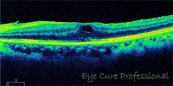 黄斑上膜状態の眼底断面図