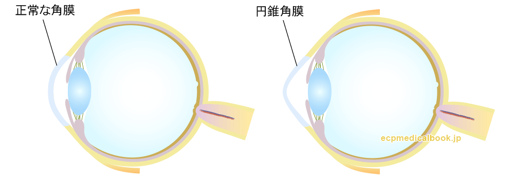 正常な角膜と円錐角膜