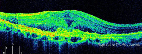 加齢黄斑変性の網膜の断面OCT画像