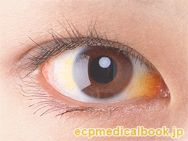 瞼裂斑の目