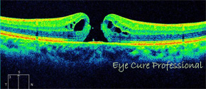 黄斑円孔状態の網膜断面図