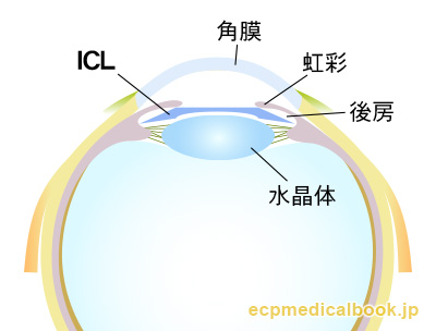 後房にICLが入っている様子