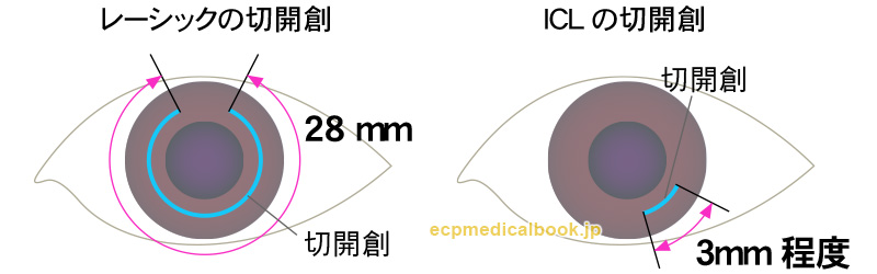 ICLの場合角膜の切開創は3mm程度