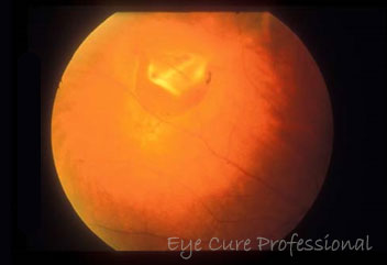 網膜剥離裂孔治療前の眼底写真