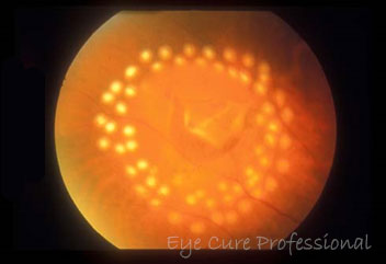網膜剥離裂孔治療後の眼底写真