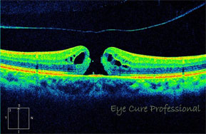 黄斑円孔状態の眼底断面図