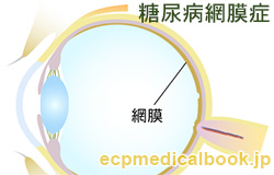 糖尿病網膜症：網膜の位置