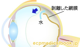 網膜剥離のようす