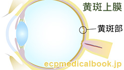 黄斑上膜：黄斑部