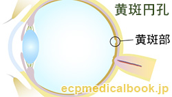 黄斑円孔：黄斑部