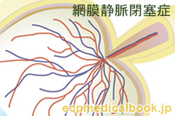 網膜静脈閉塞症：網膜のの血管の様子