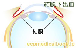 結膜下出血：結膜の位置
