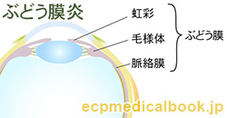 ぶどう膜炎：ぶどう膜炎の位置