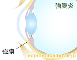 強膜炎：強膜の位置