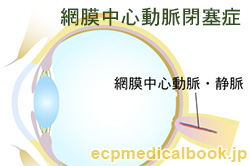 網膜中心動脈閉塞症：網膜中心動脈の位置