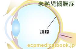 未熟児網膜症：網膜の位置
