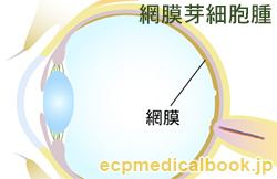 網膜芽細胞腫：網膜の位置
